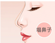 呼和浩特市玻尿酸隆鼻的維持時間是多久?