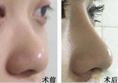 呼和浩特市隆鼻修復安全性如何?