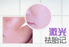 呼和浩特市哪里有激光祛胎記的