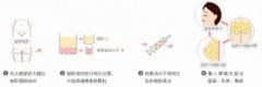 呼和浩特整形醫(yī)院自體脂肪填充有哪些優(yōu)勢(shì)?