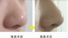 呼和浩特整形醫(yī)院假體隆鼻多少錢呢?