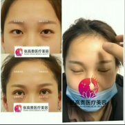 呼和浩特雙眼皮術(shù)后怎么護(hù)理呢?