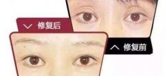 呼和浩特整形雙眼皮修復(fù)需要注意些什么呢?