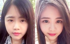 呼和浩特整形有哪些眼部整形項(xiàng)目?