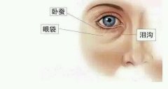 呼和浩特眼部整形眼袋和臥蠶有哪些區(qū)別呢?