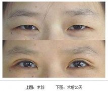 呼和浩特雙眼皮整形割雙眼皮好還是埋線好呢?