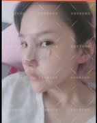 呼市鼻部整形韓式隆鼻有什么優(yōu)勢呢?