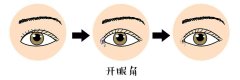 呼市整形開眼角適合的人有哪些,不適合的有哪些?