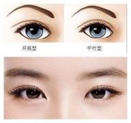 呼和浩特割雙眼皮要花多少錢?