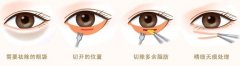 祛眼袋手術(shù)安全嗎?