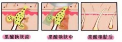 呼和浩特做完果酸換膚后需要注意些什么?