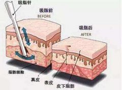 抽脂手術(shù)前需要注意什么?