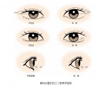 呼和浩特雙眼皮修復(fù)效果怎么樣?