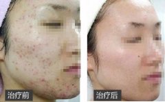 果酸換膚做一次多少錢?