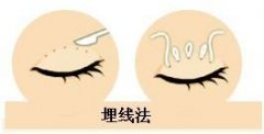 埋線雙眼皮和全切雙眼皮的區(qū)別有哪些?