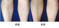 脫腿毛有什么有用的方法?