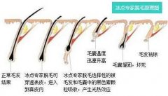 激光脫腋毛對身體排汗有害處嗎?
