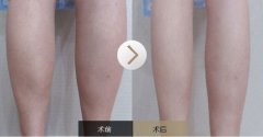 呼和浩特注射瘦腿針哪家醫(yī)院效果好?