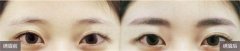 呼和浩特哪家醫(yī)院紋眉好?