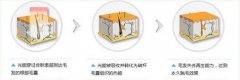 呼和浩特做激光脫唇毛多少錢?