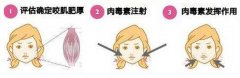呼和浩特哪家醫(yī)院瘦臉針效果好?
