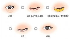 呼和浩特祛眼袋手術多少錢?