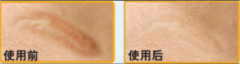 激光去疤痕多少錢?