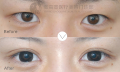 呼和浩特可以內(nèi)外眼角都開嗎?
