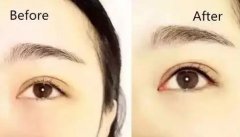 呼和浩特整形紋美瞳線會(huì)痛嗎?