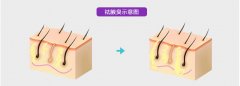 哪些方法能解決腋臭問題呢?