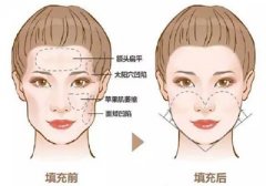 下巴整形會有危險嗎?