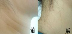呼市射頻緊膚除皺費用貴嗎?