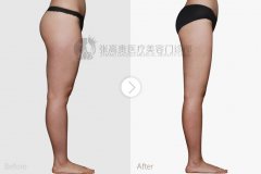 呼市大腿吸脂副作用怎么樣?