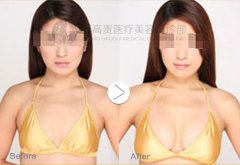 呼市豐胸手術(shù)貴不貴?
