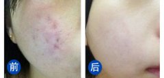 呼市激光去痘印多少錢(qián)?