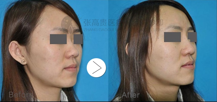呼市膨體隆鼻好不好?