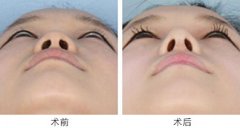 呼市鼻小柱延長手術(shù)安全嗎?