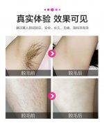 呼和浩特激光脫毛有危險嗎?
