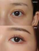 呼和浩特去黑眼圈注意事項有哪些?