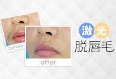 唇部脫毛貴不貴?注意事項(xiàng)是什么?