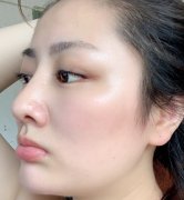 做膨體隆鼻手術需要多少錢