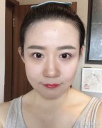 呼和浩特做假體隆鼻手術(shù)術(shù)后該怎么護(hù)理
